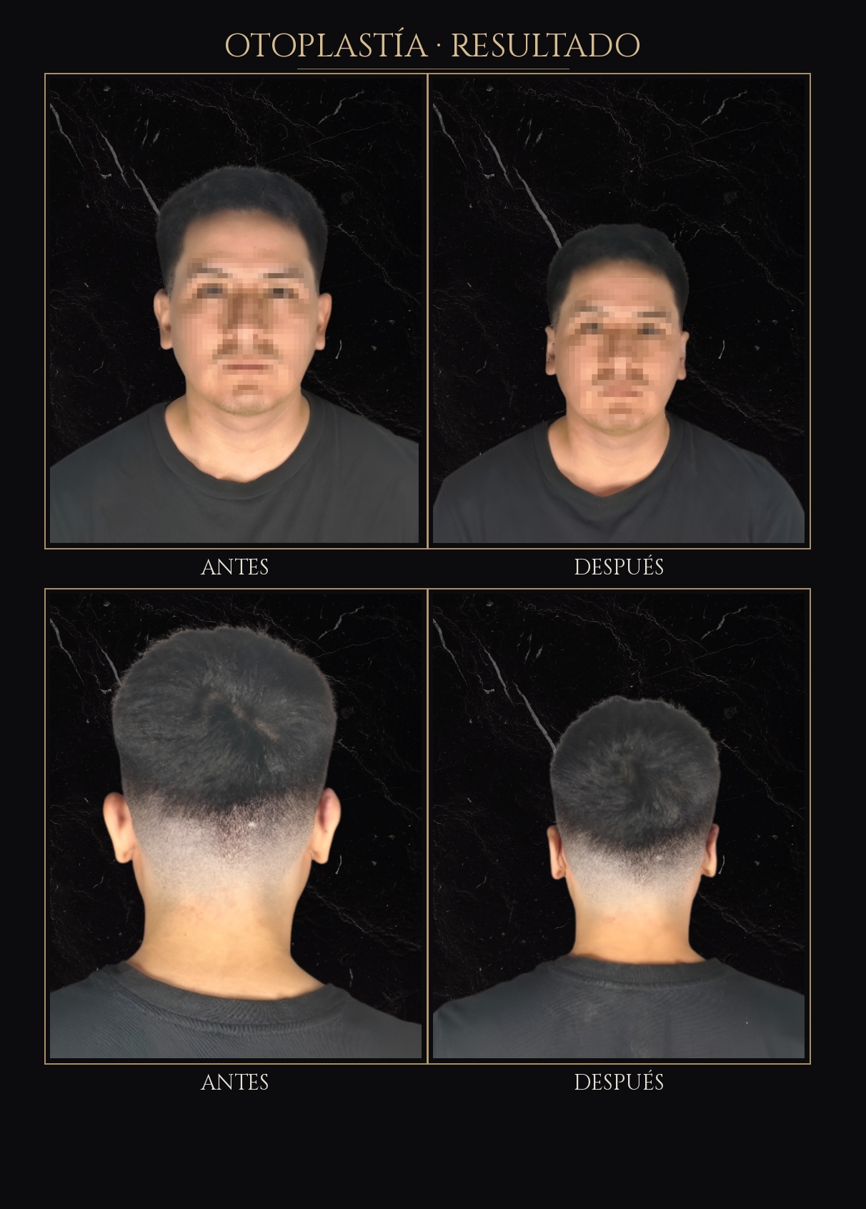 Caso de otoplastía 01 - Antes y después - Dr. Luis Borja