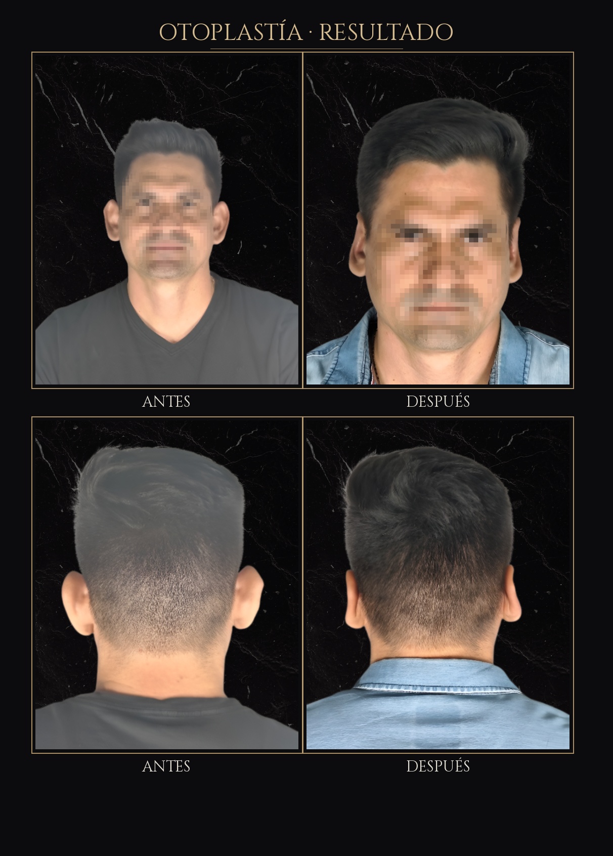 Caso de otoplastía 02 - Antes y después - Dr. Luis Borja